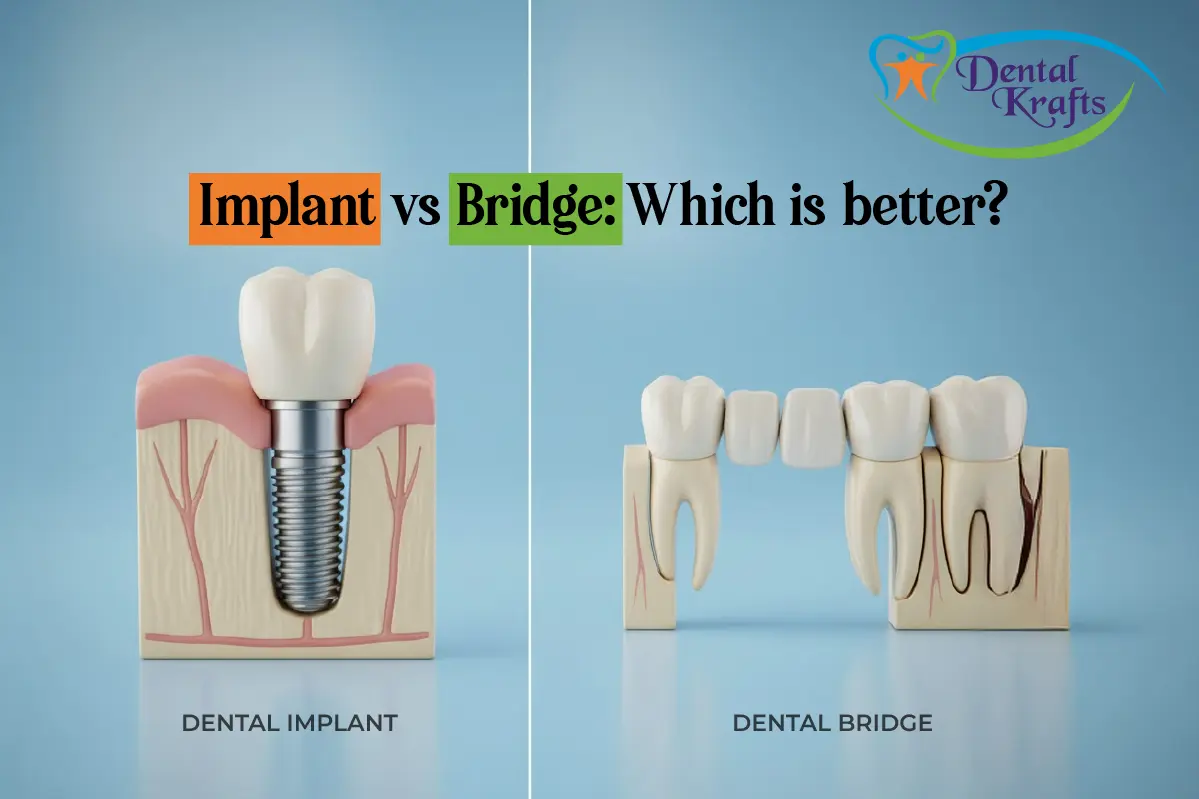 Implant vs Bridge