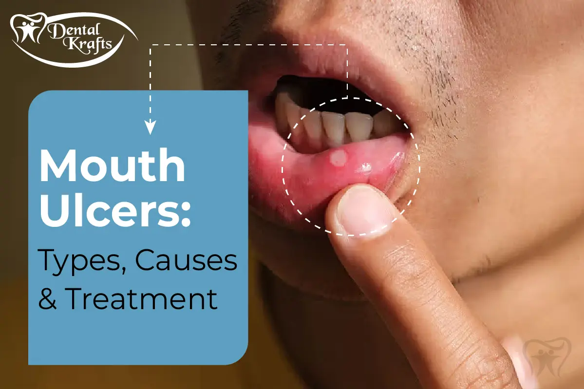 Mouth ulcers