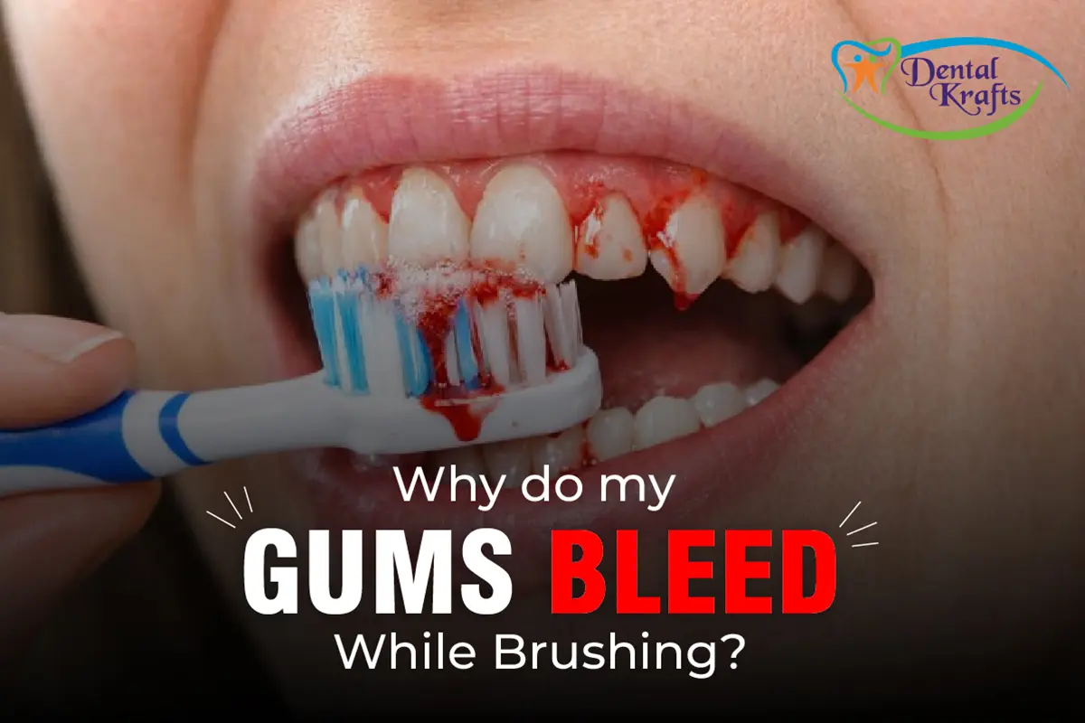 Gums Bleed