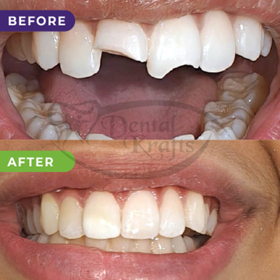 fixed teeth treatment