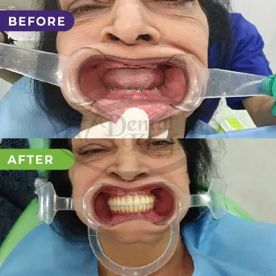 Full mouth rehabiliation gurgaon