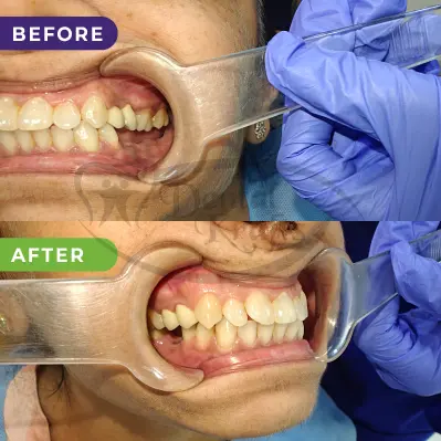 Back teeth implant treatment gurgaon