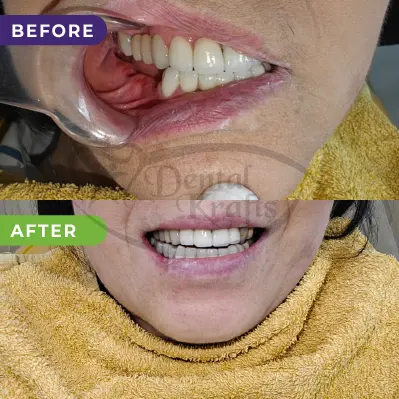 back implant teeth gurgaon