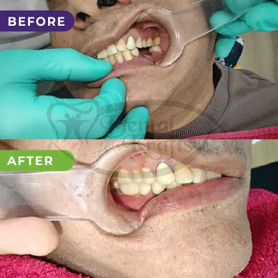 back teeth implant gurugram