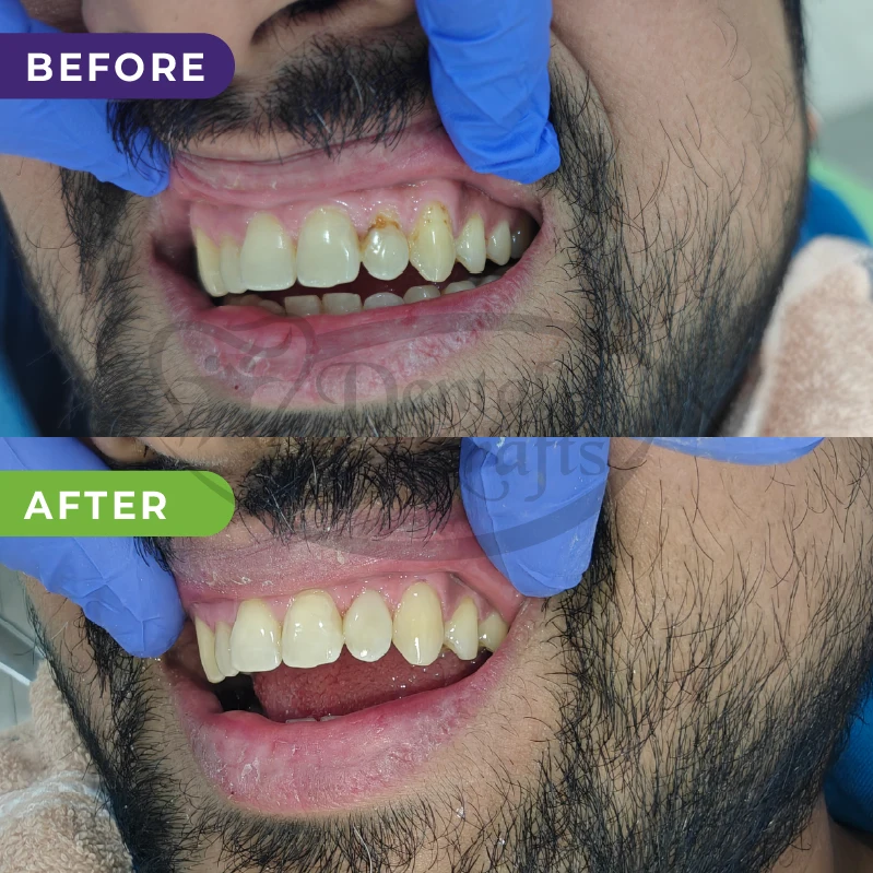 teeth cleaning treatment gurugram