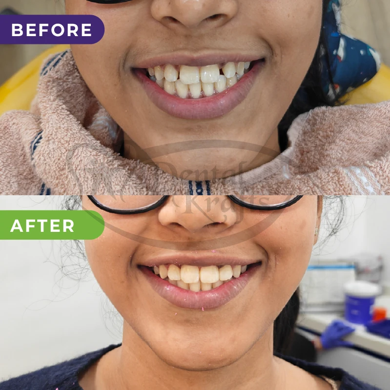 gap filling treatment gurugram